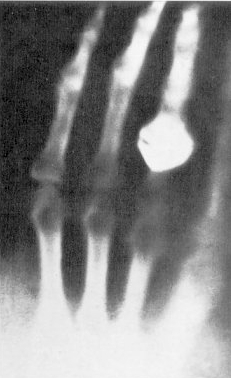 Röntgenov prvý snímok - ruka jeho manželky